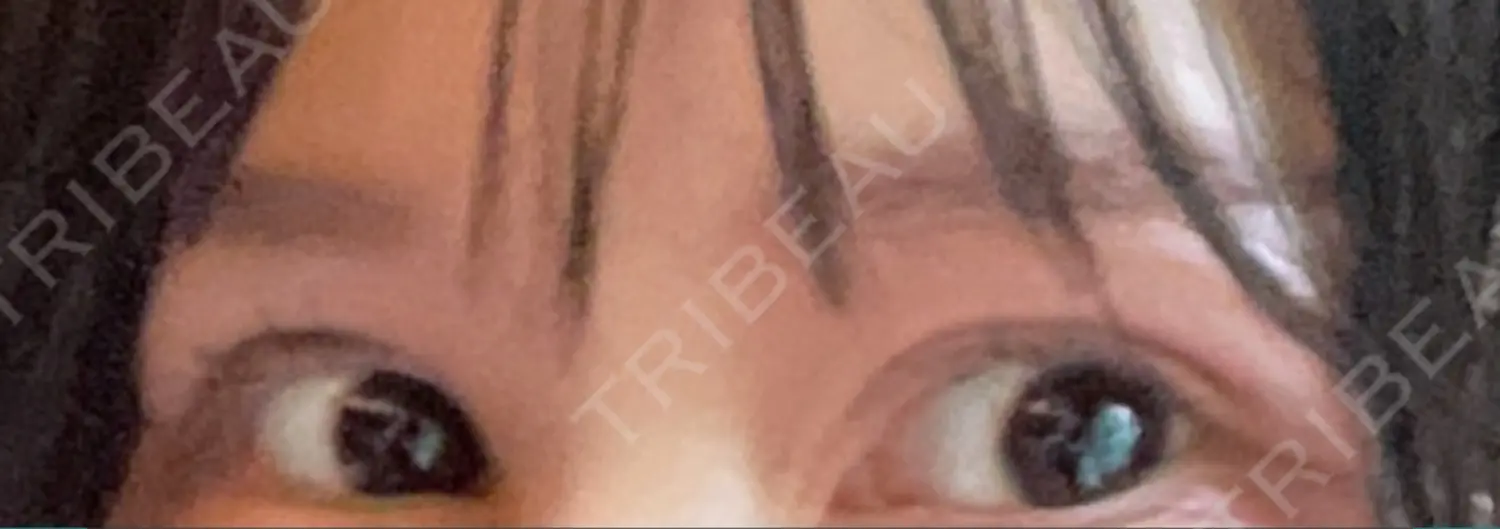 施術後の写真