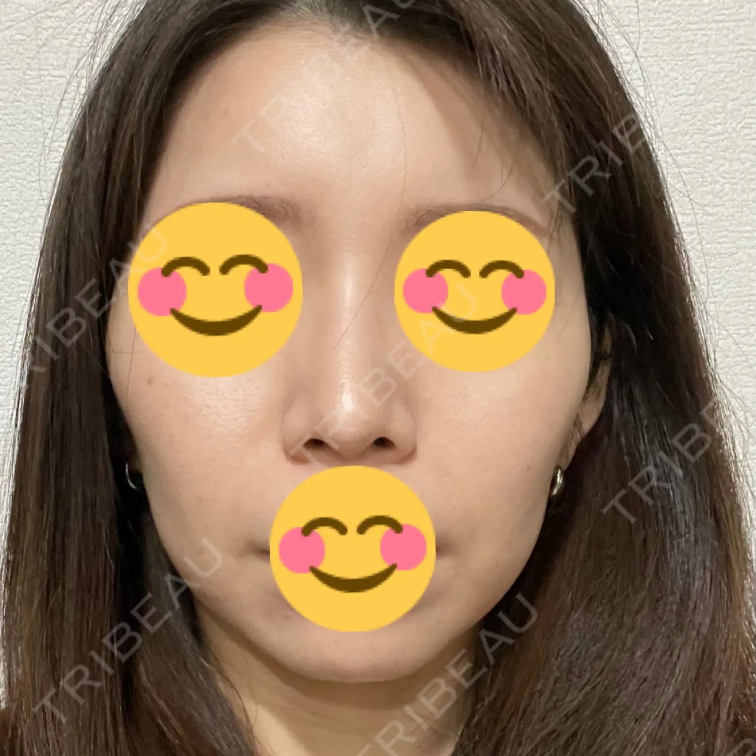 施術後の写真