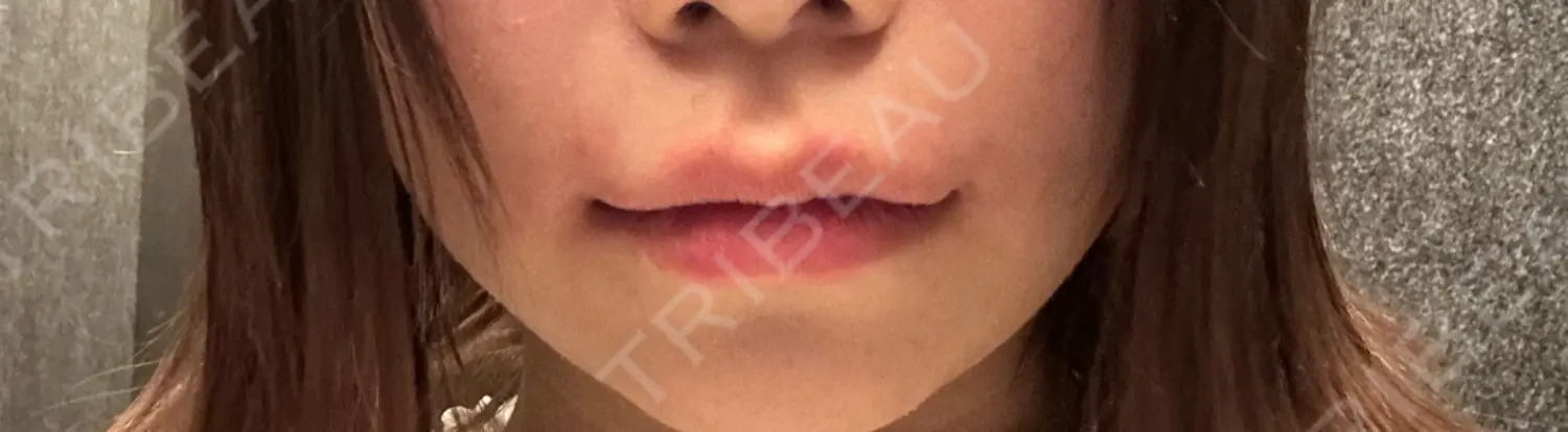 施術後の写真