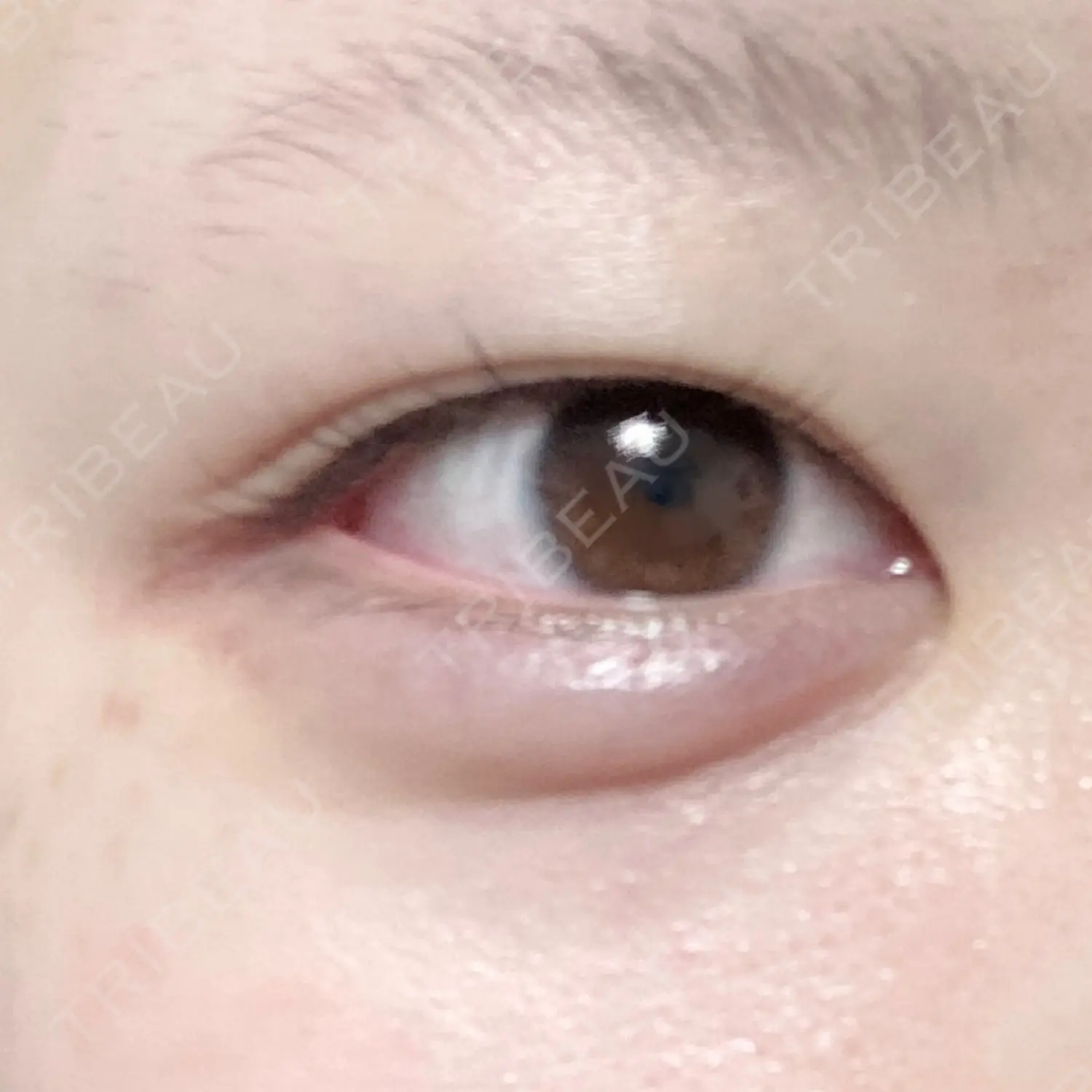 施術後の写真