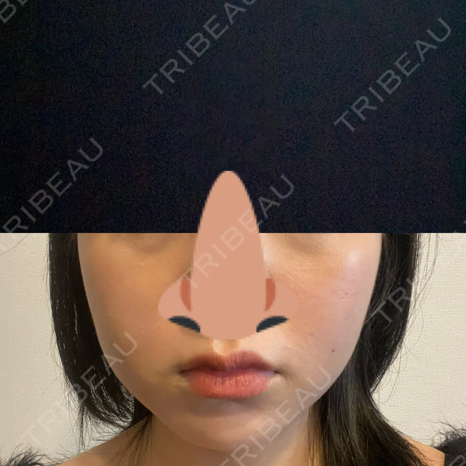施術後の写真