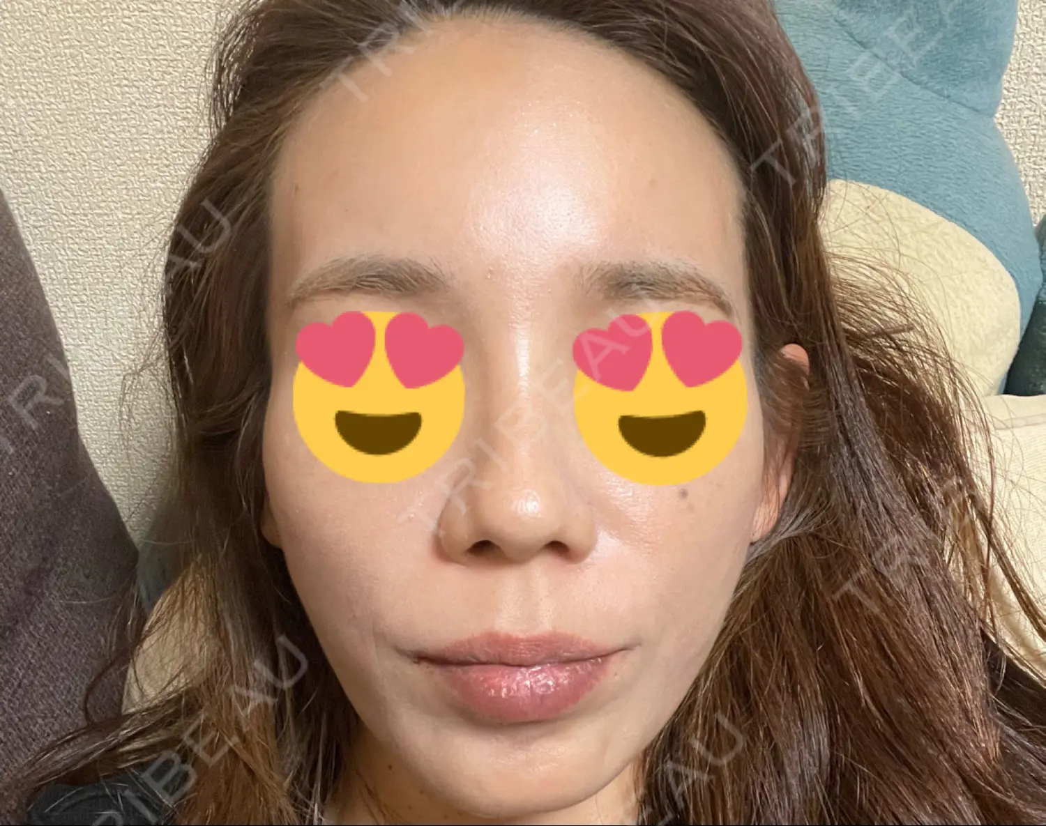 施術後の写真