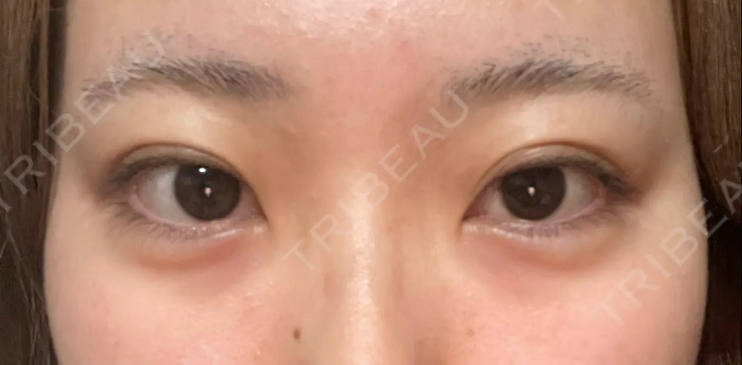 施術後の写真