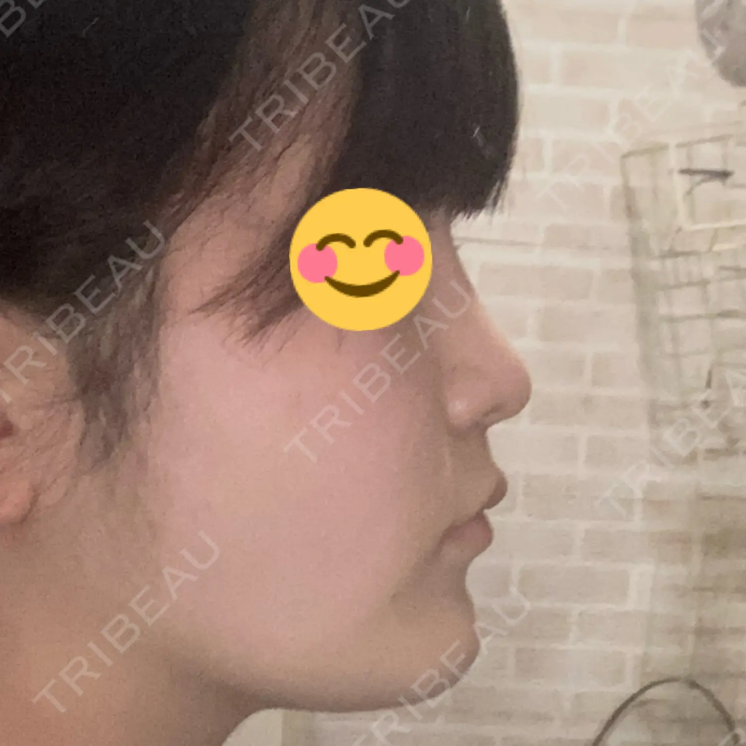 施術後の写真