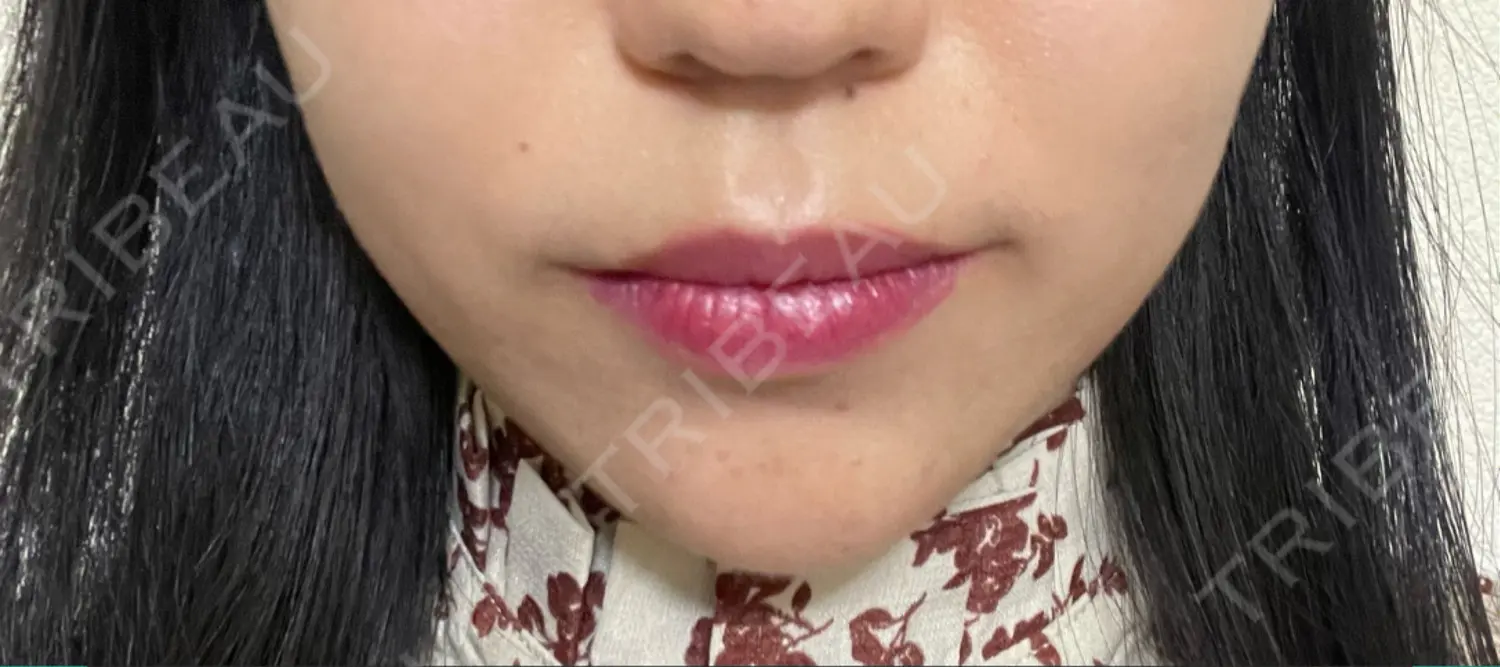 施術後の写真