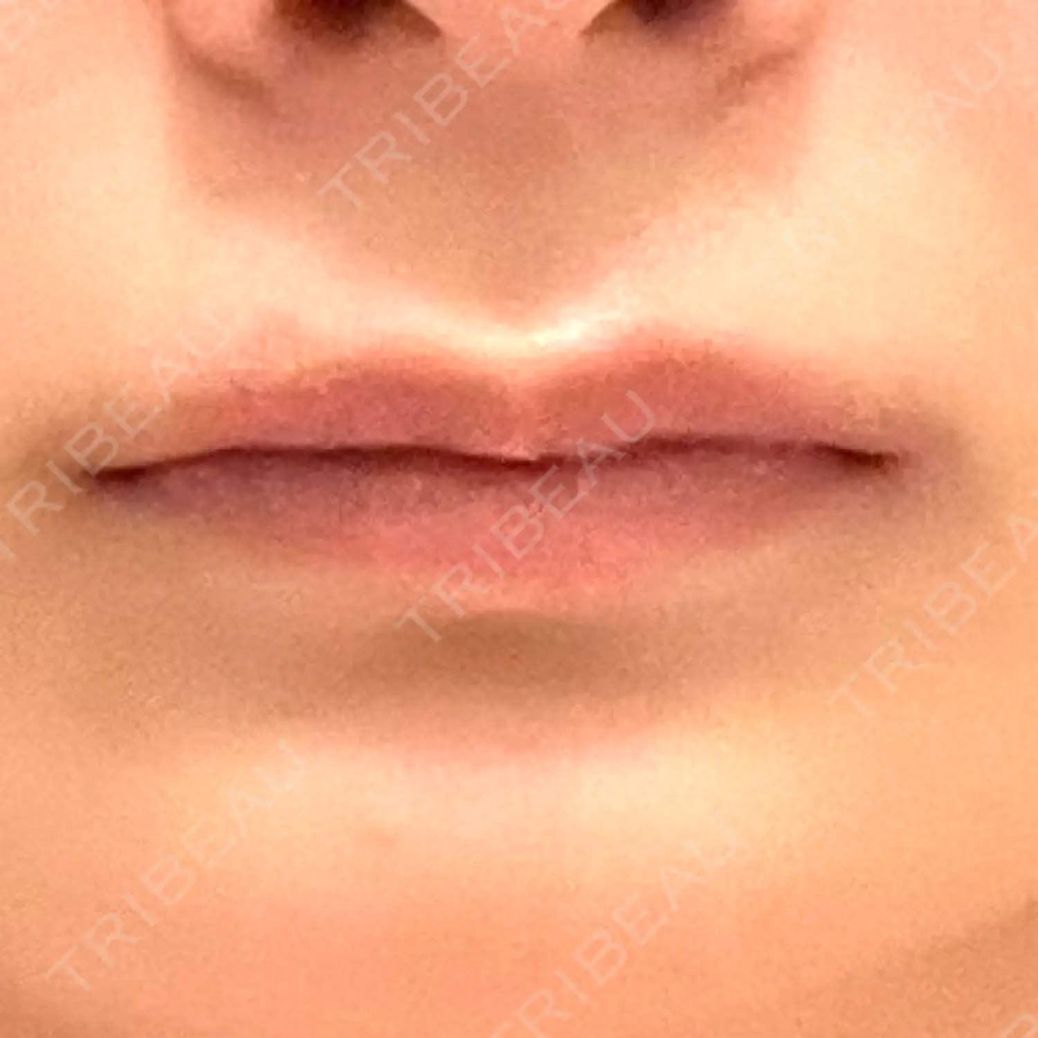 施術後の写真