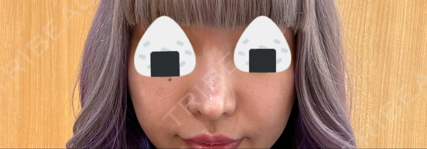 施術後の写真