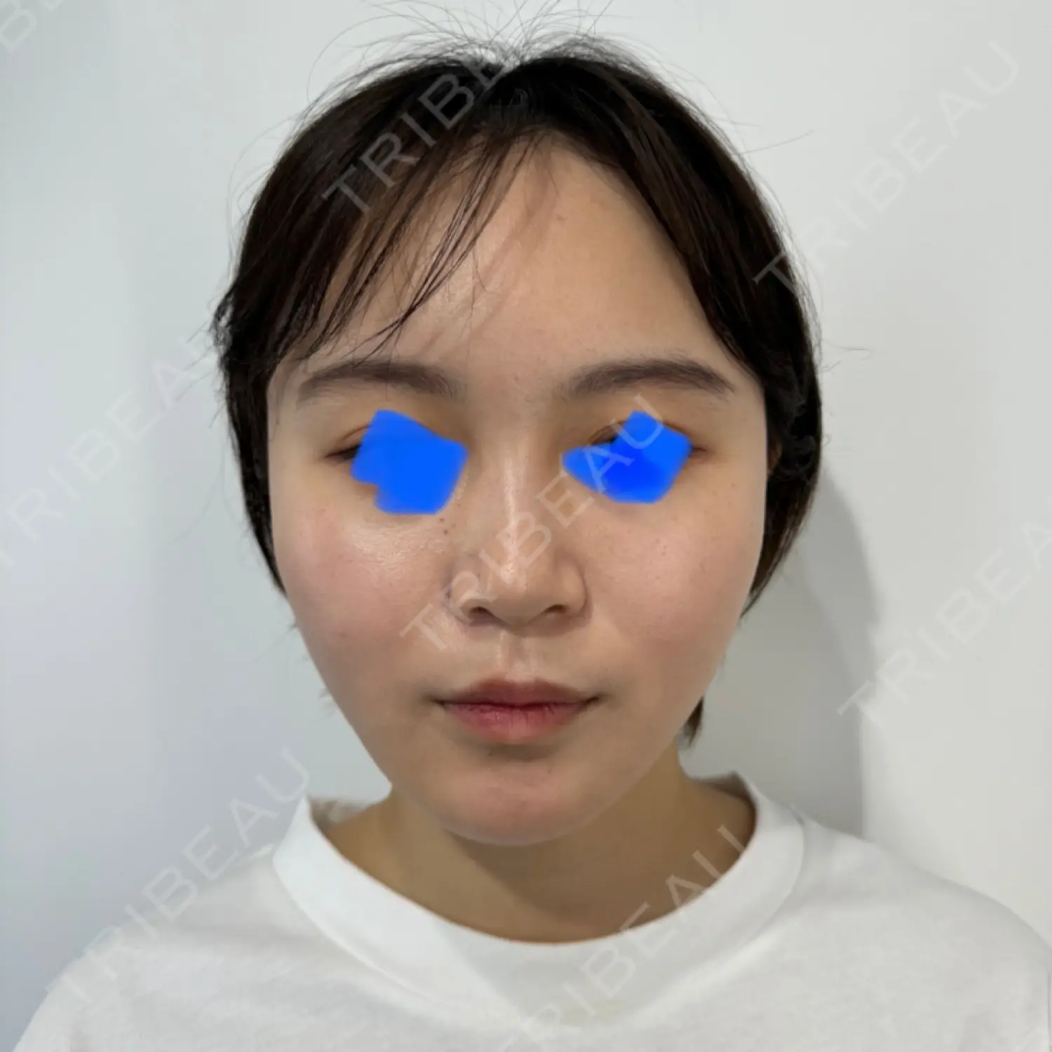 施術後の写真