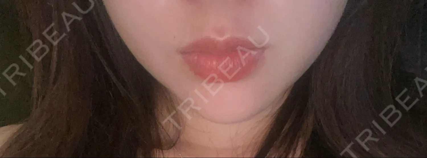 施術後の写真