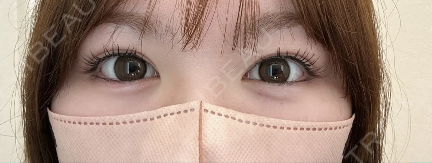 施術後の写真