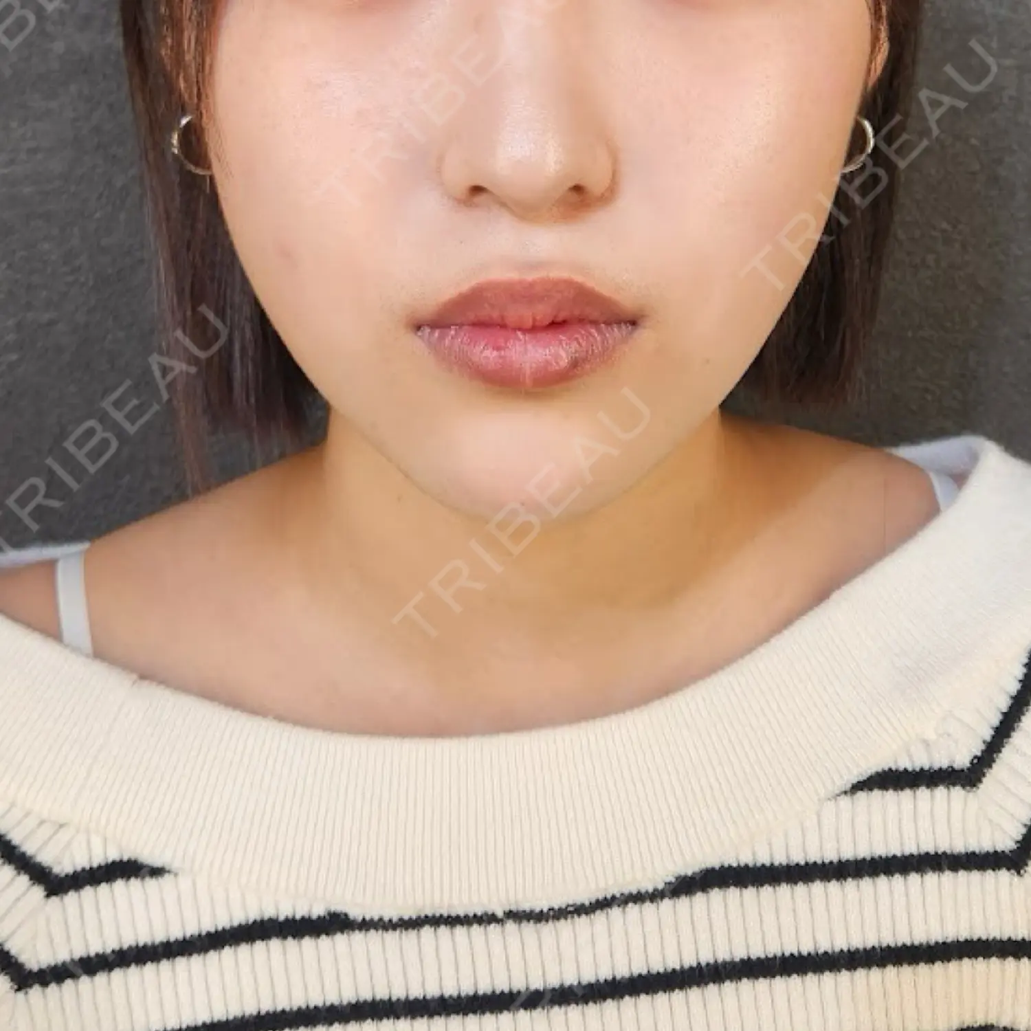 施術後の写真