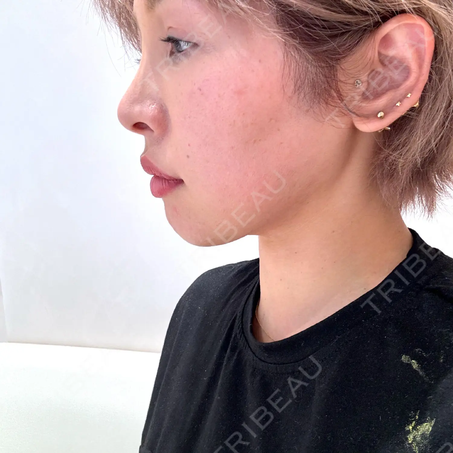 施術後の写真