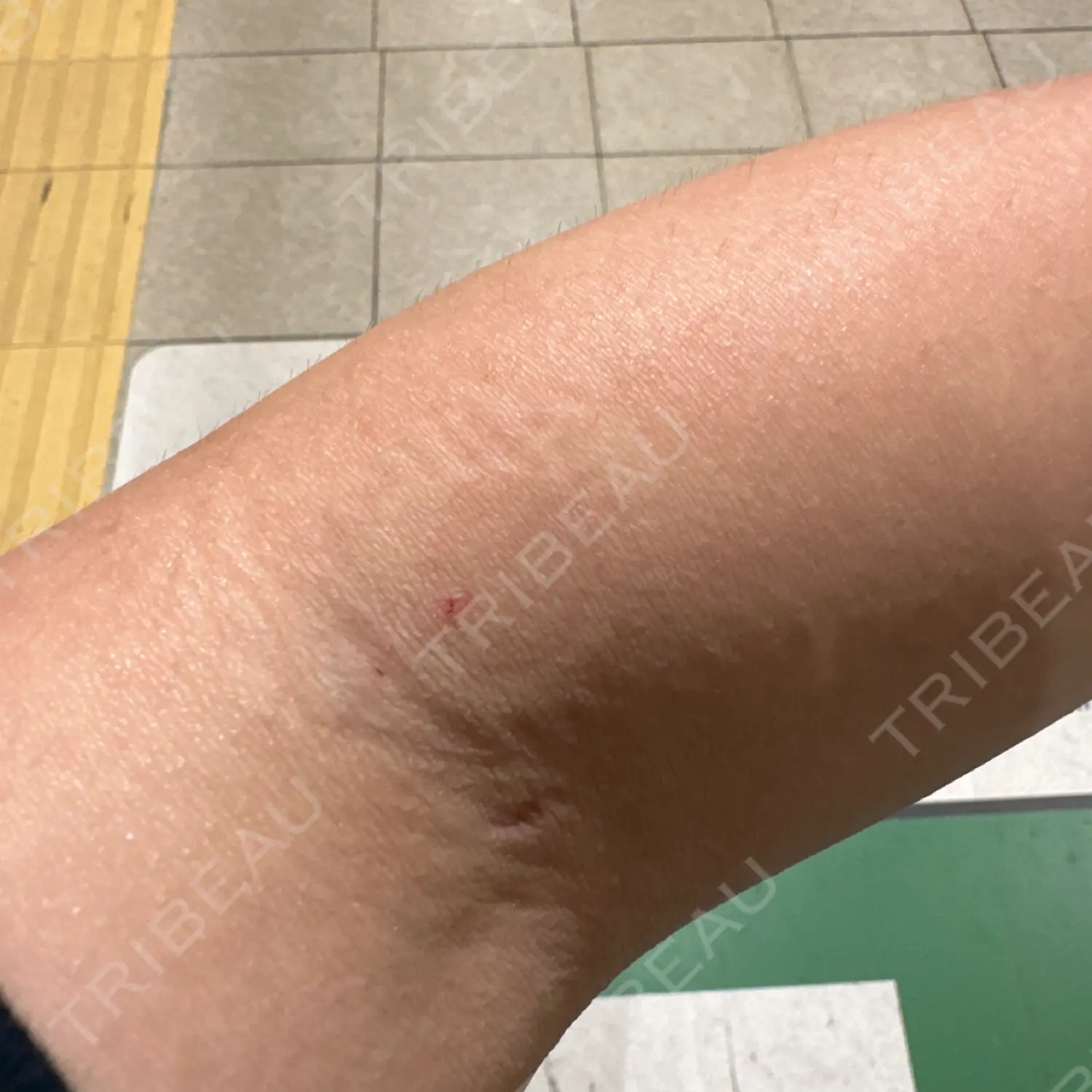 施術後の写真