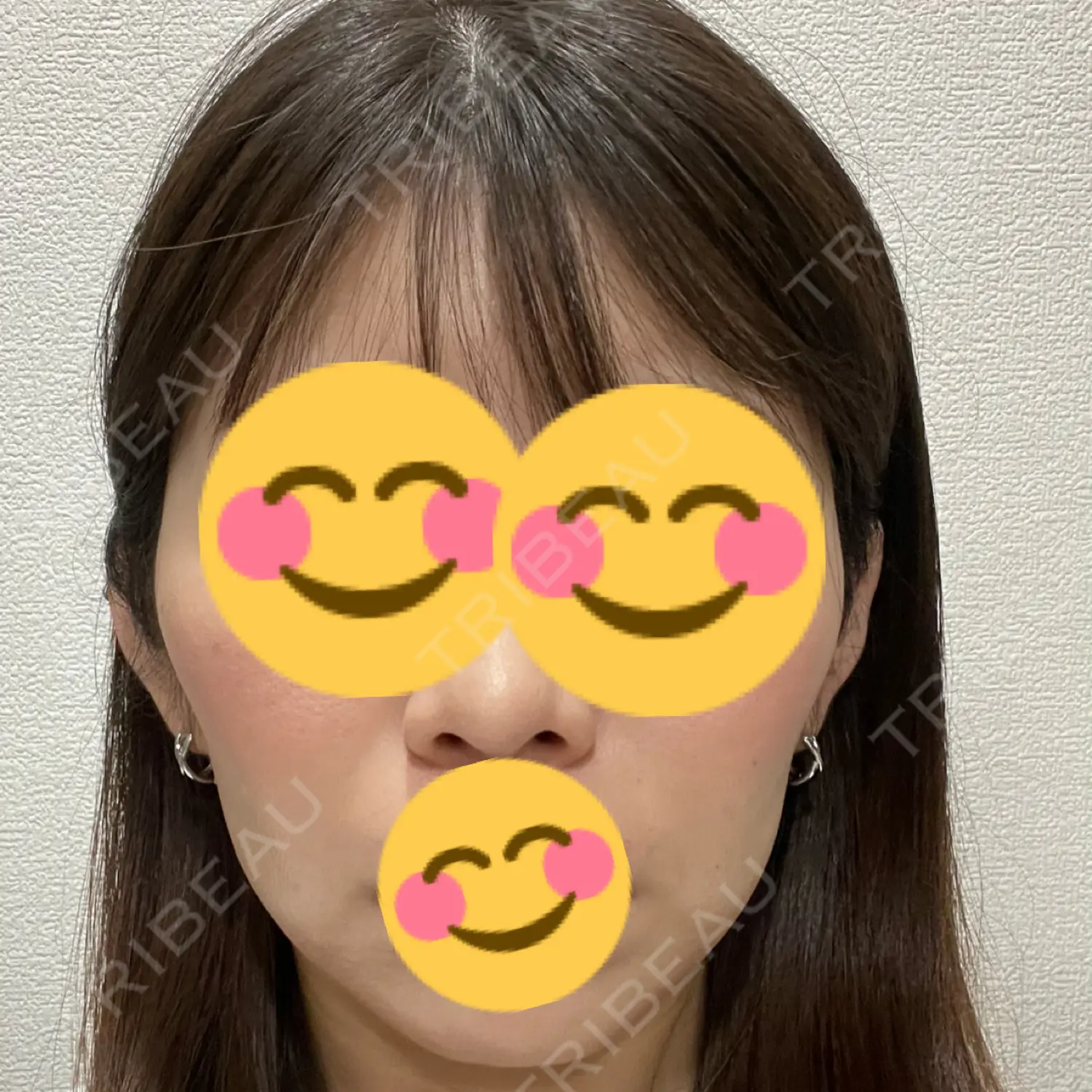 施術後の写真