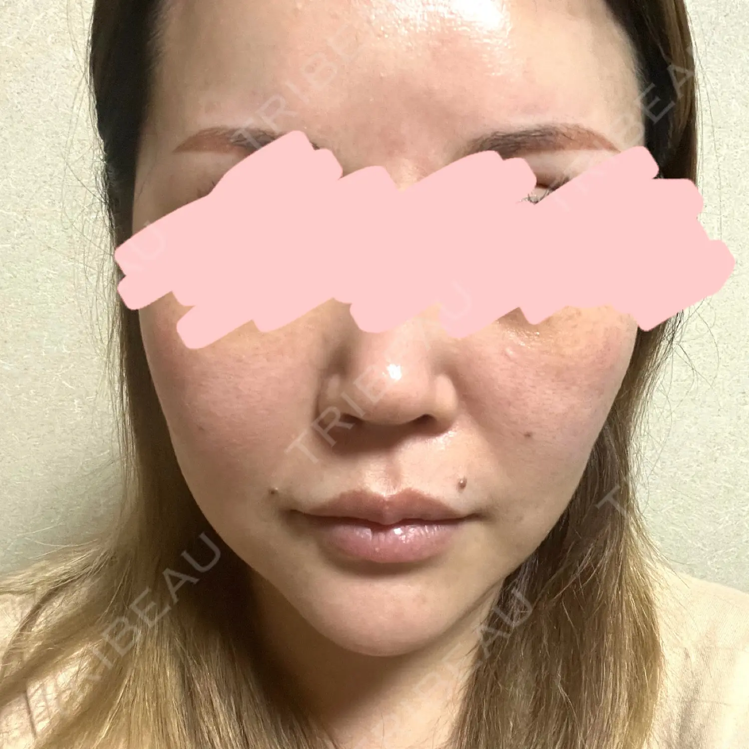 施術後の写真
