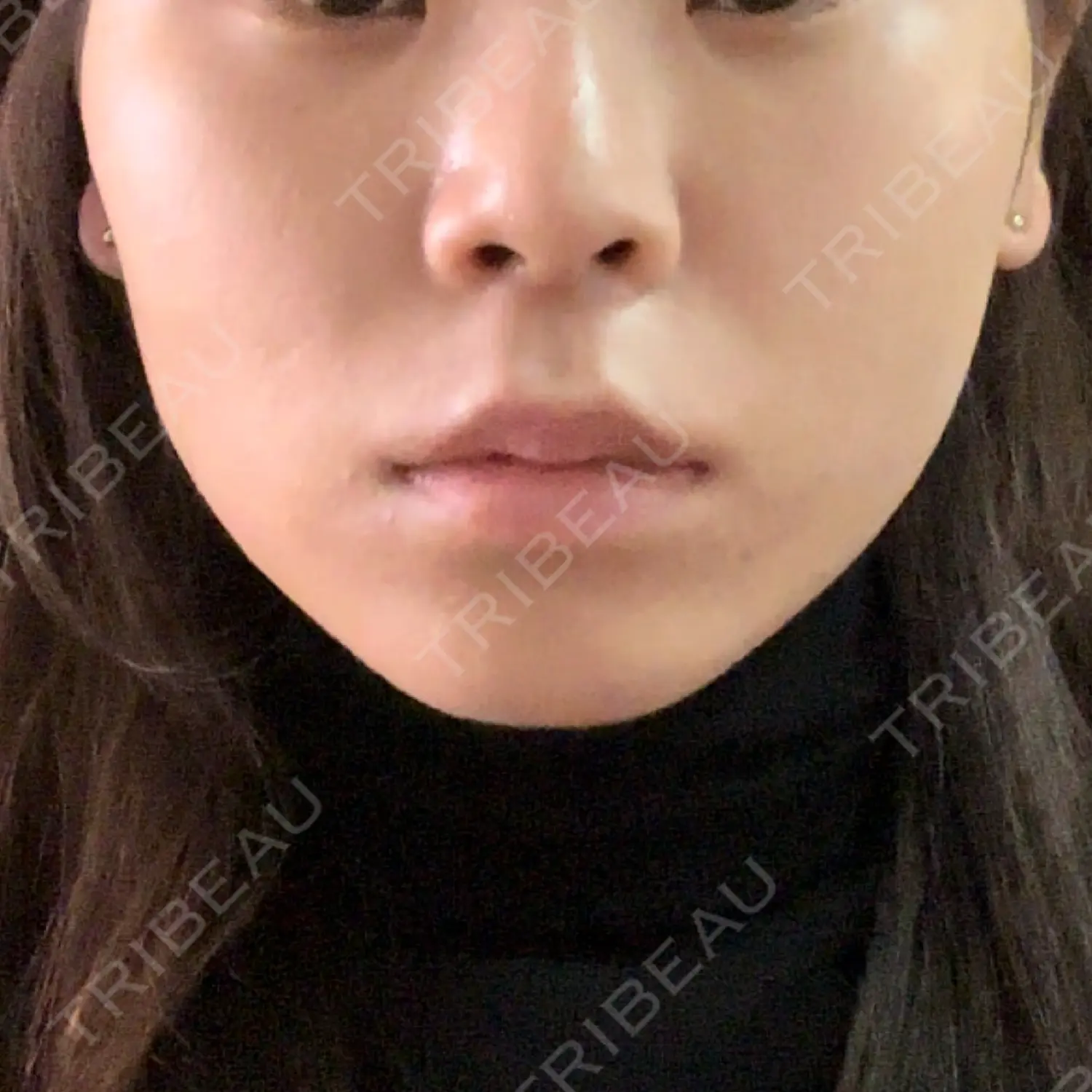 施術後の写真