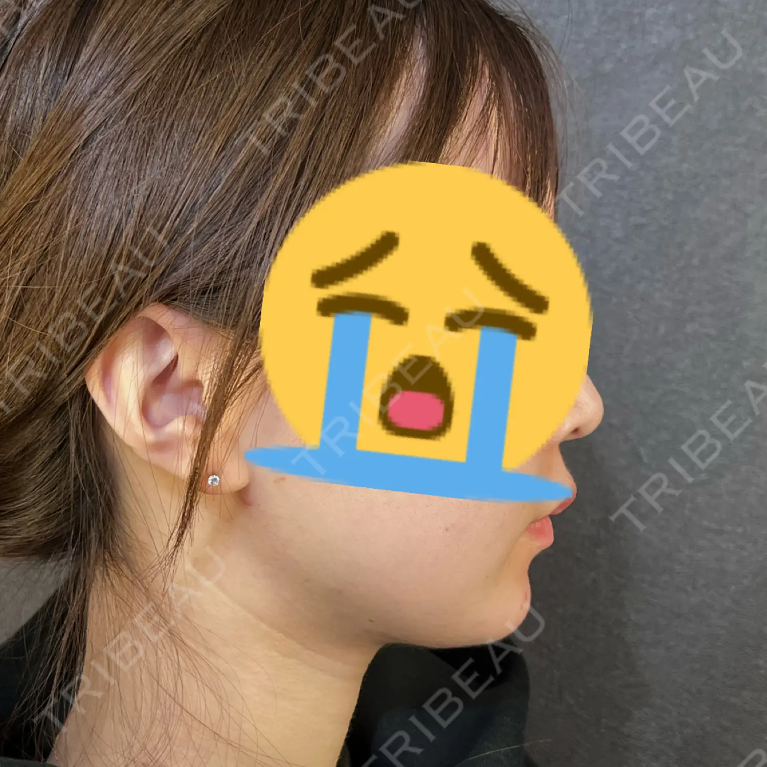 施術後の写真