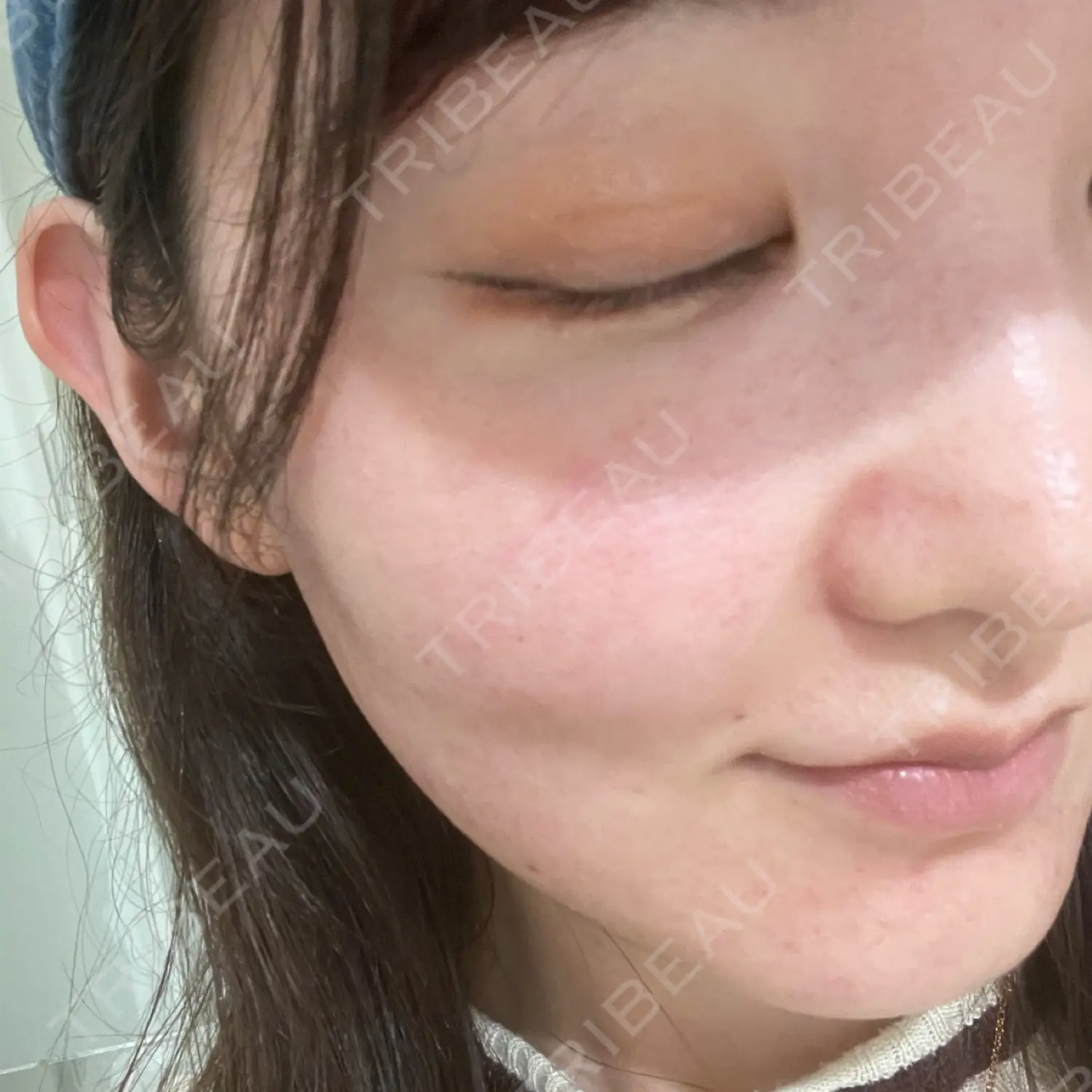 施術後の写真