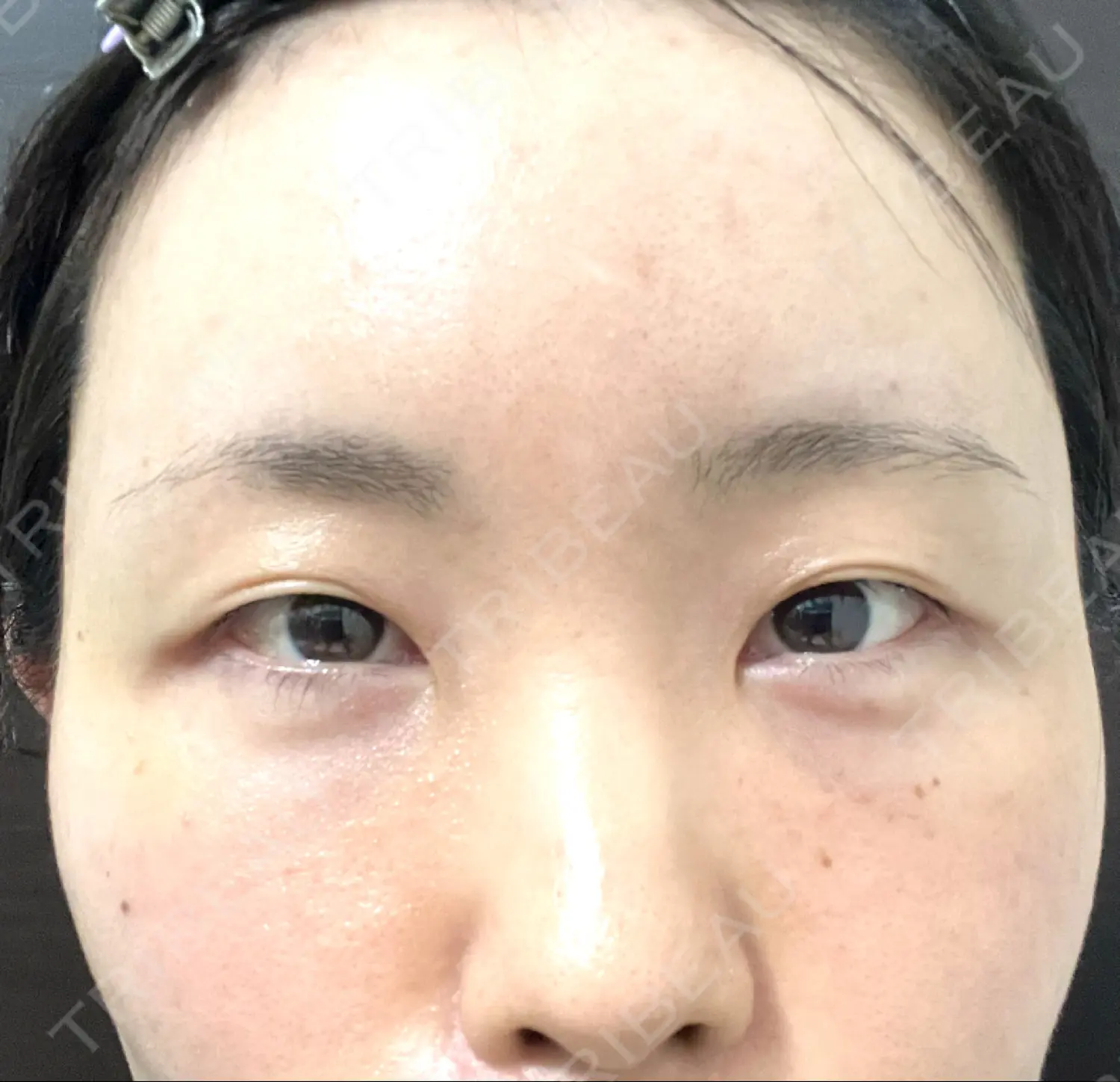 施術後の写真
