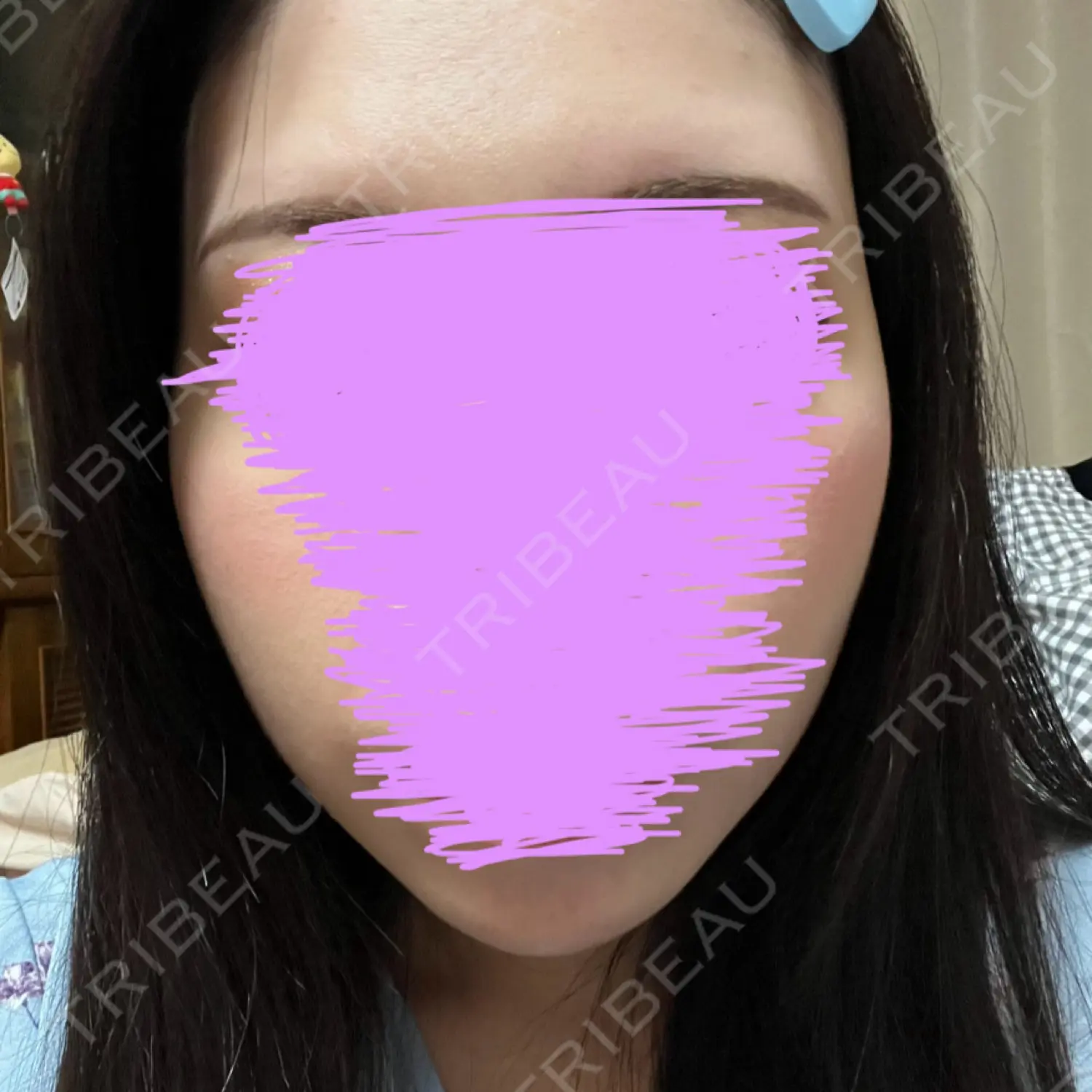 施術後の写真