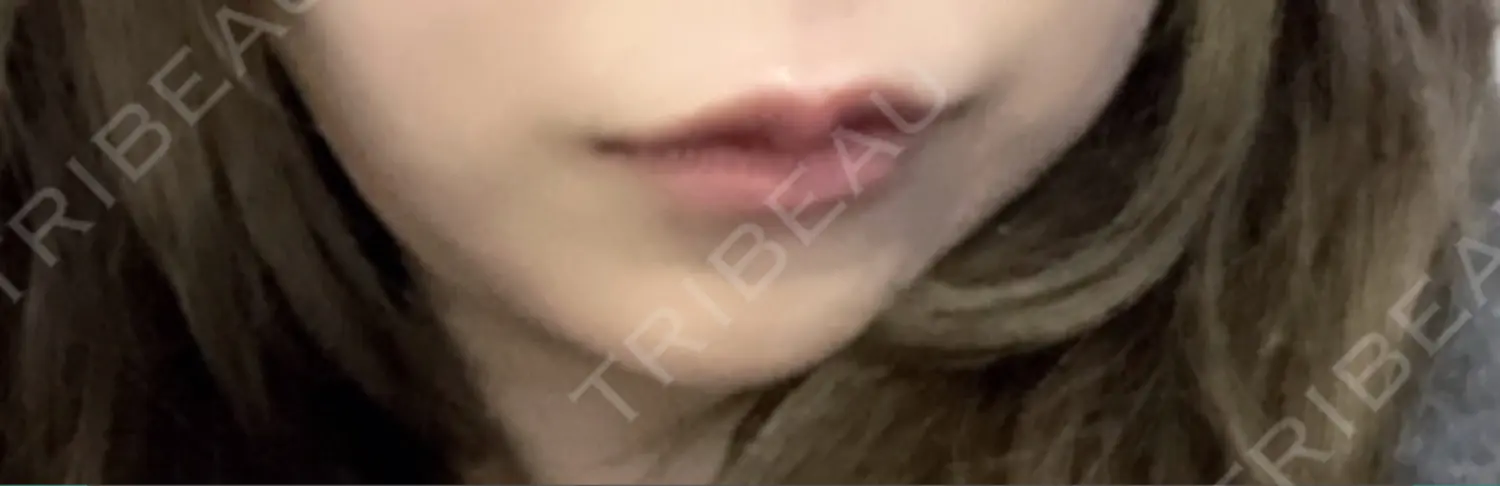 施術後の写真