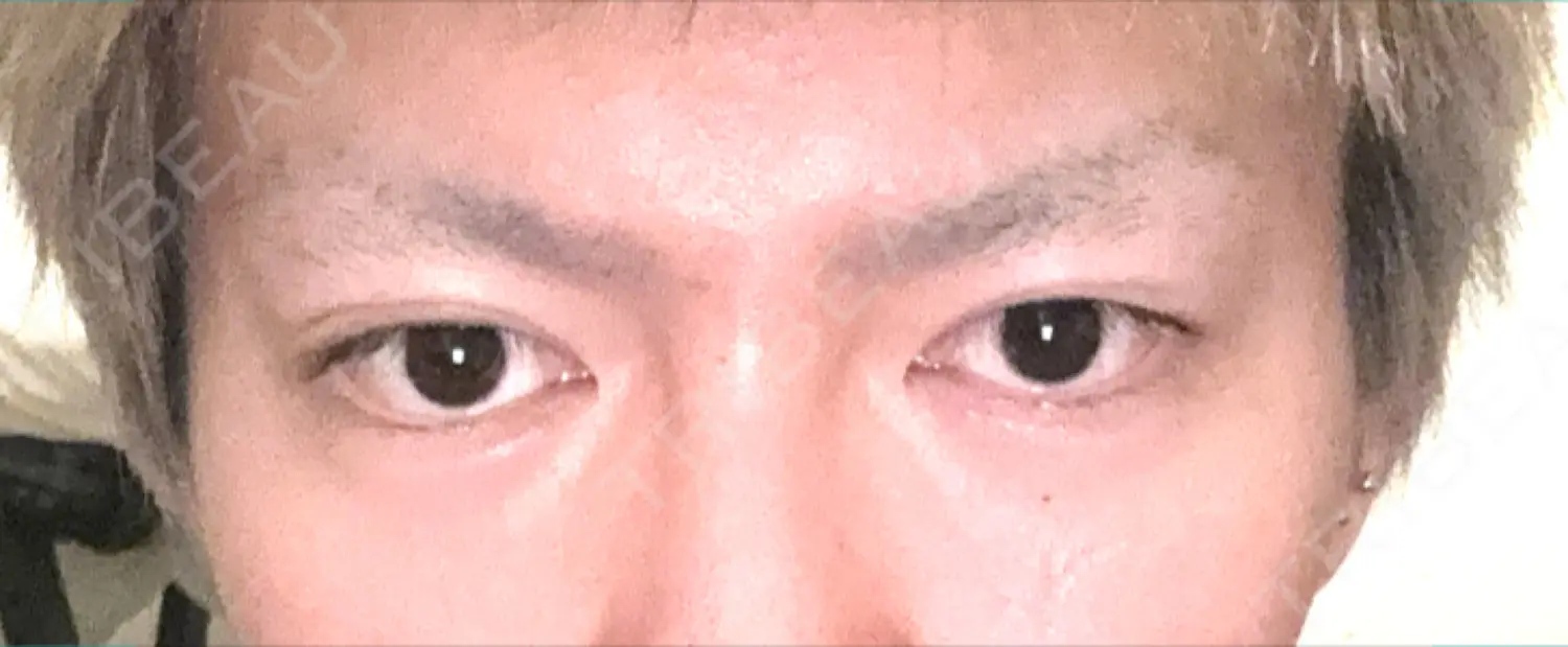 施術後の写真