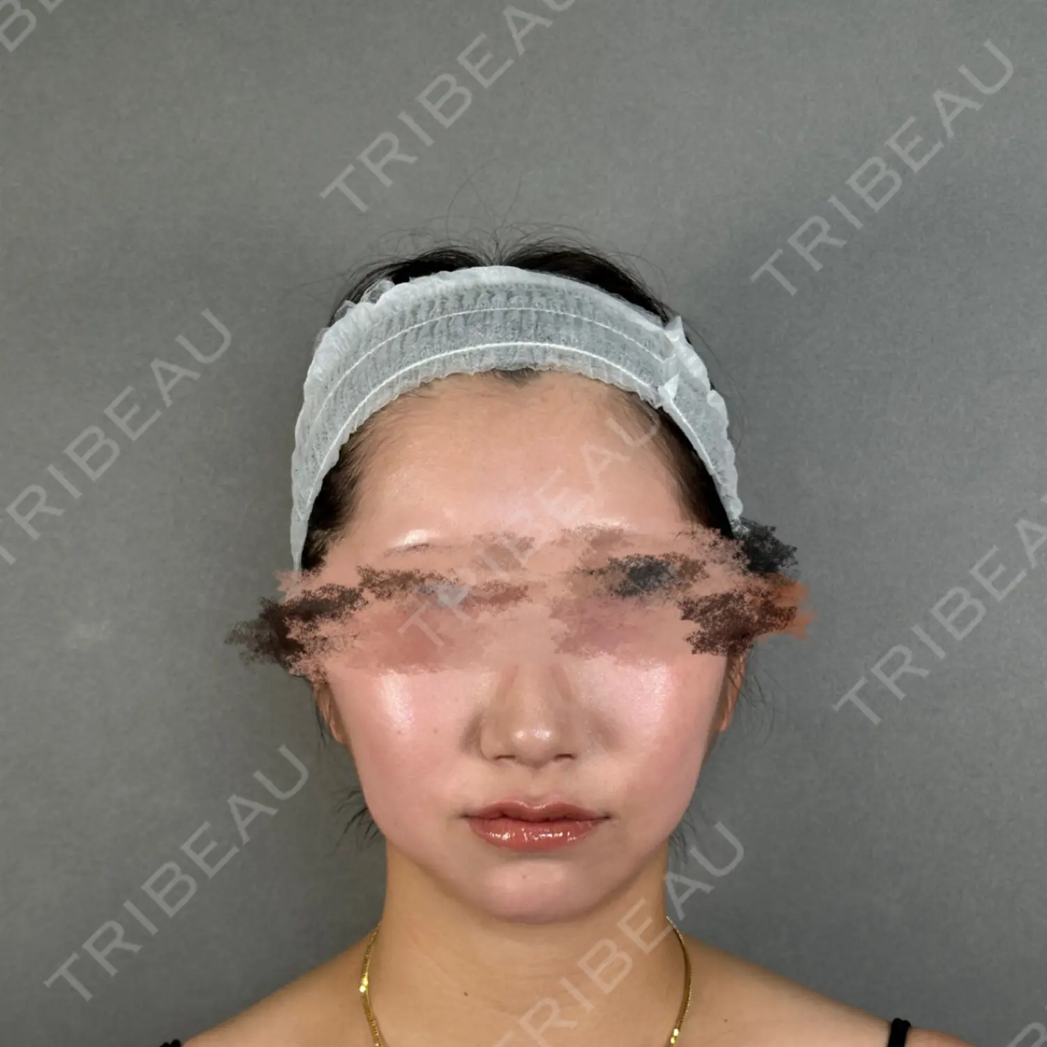 施術後の写真