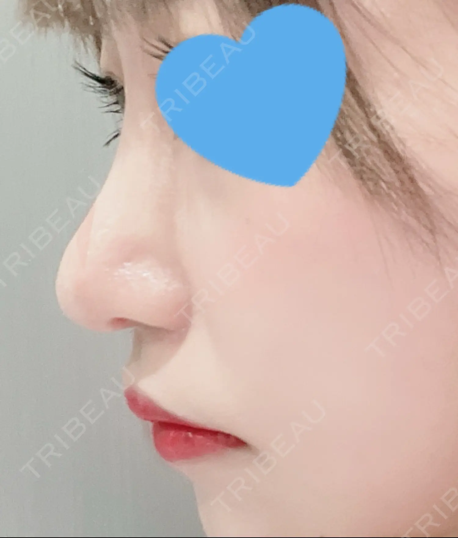 施術後の写真