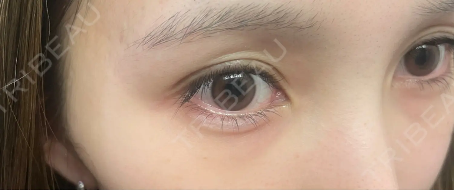 施術後の写真