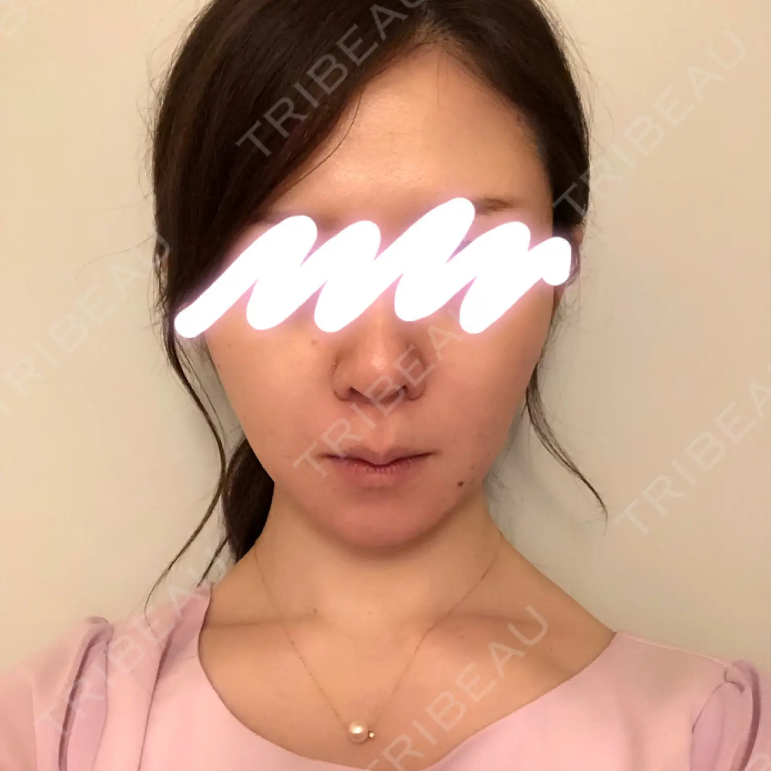 施術後の写真