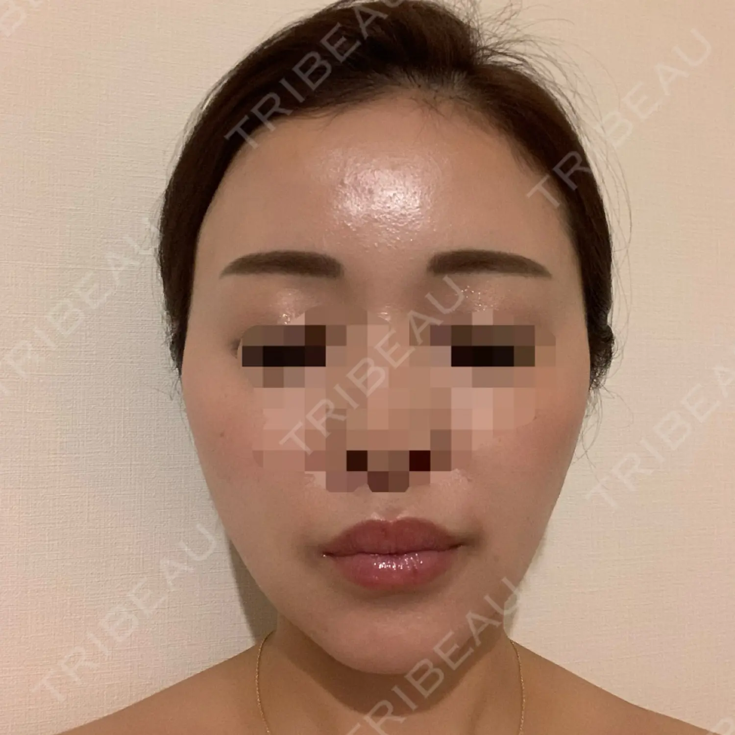 施術後の写真