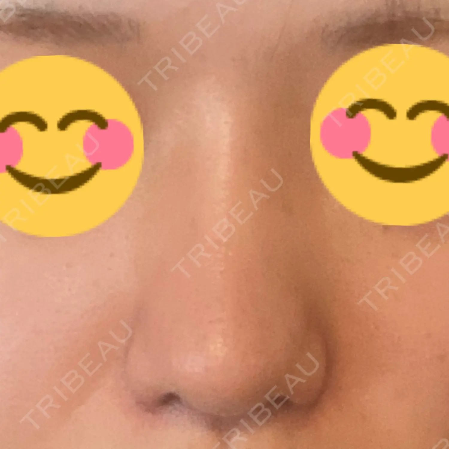 施術後の写真