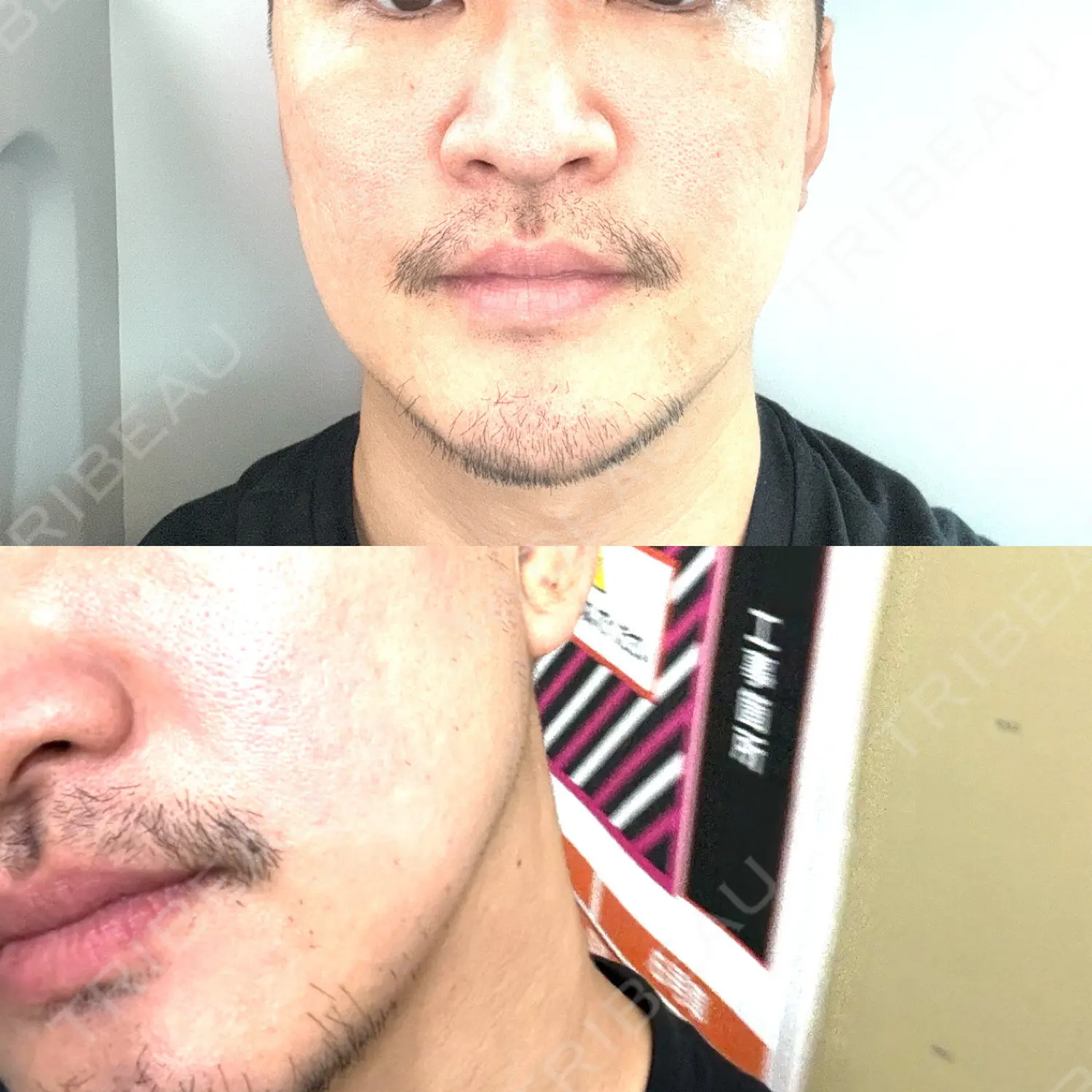 施術後の写真