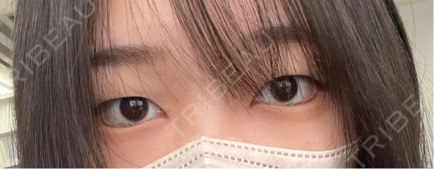 施術後の写真