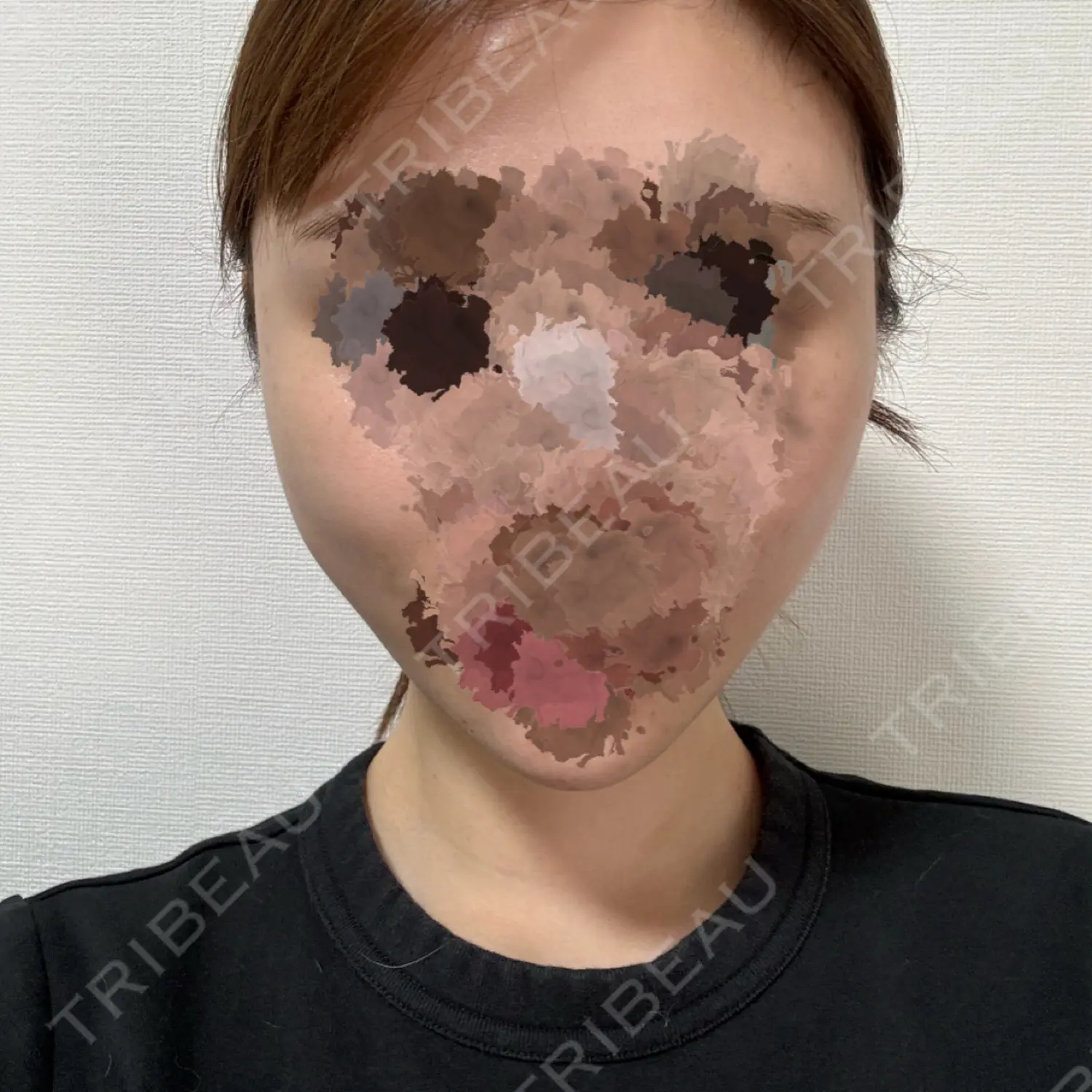 施術後の写真