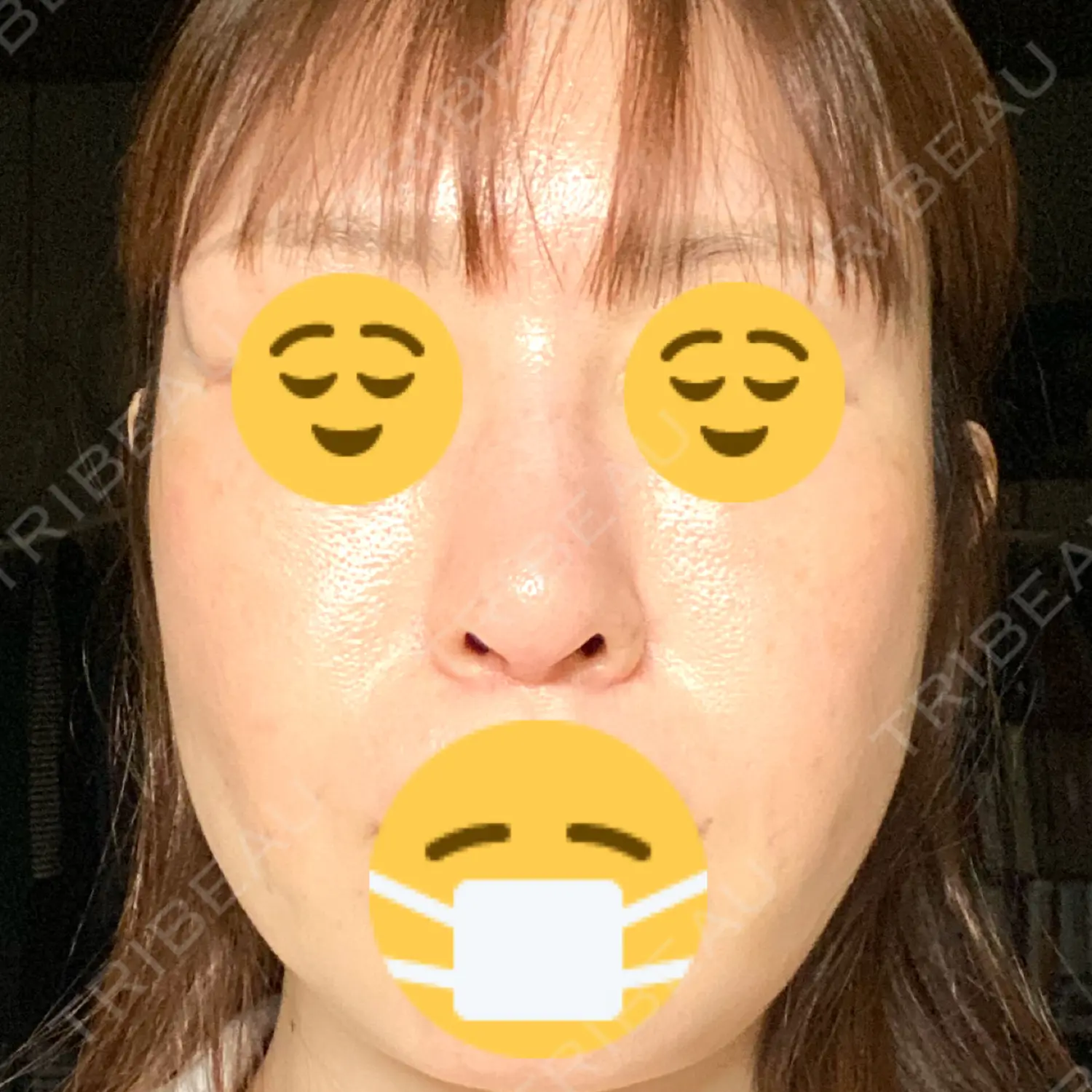 施術後の写真