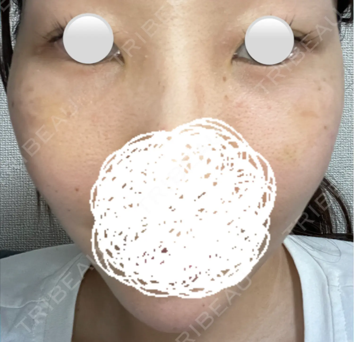 施術後の写真