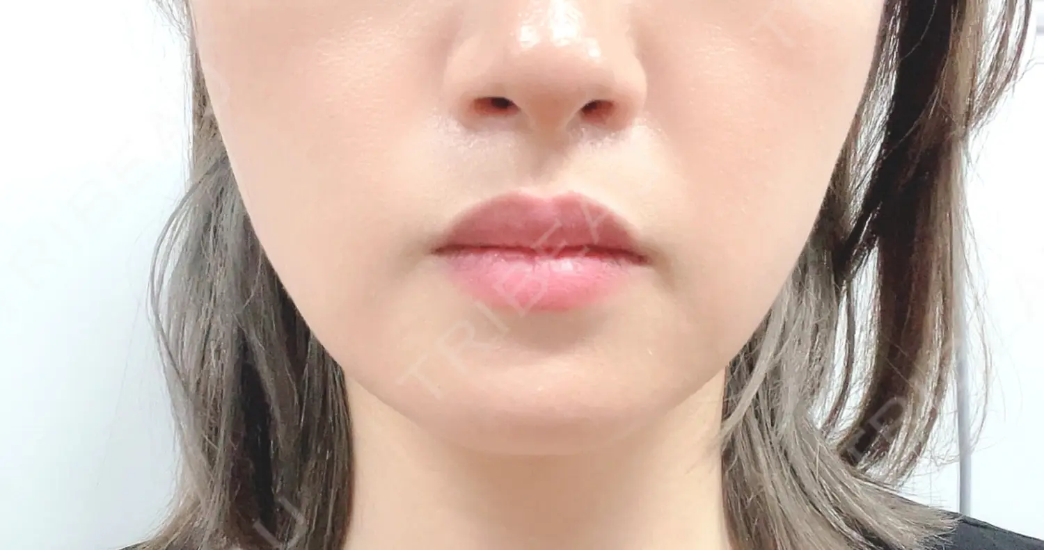 施術後の写真
