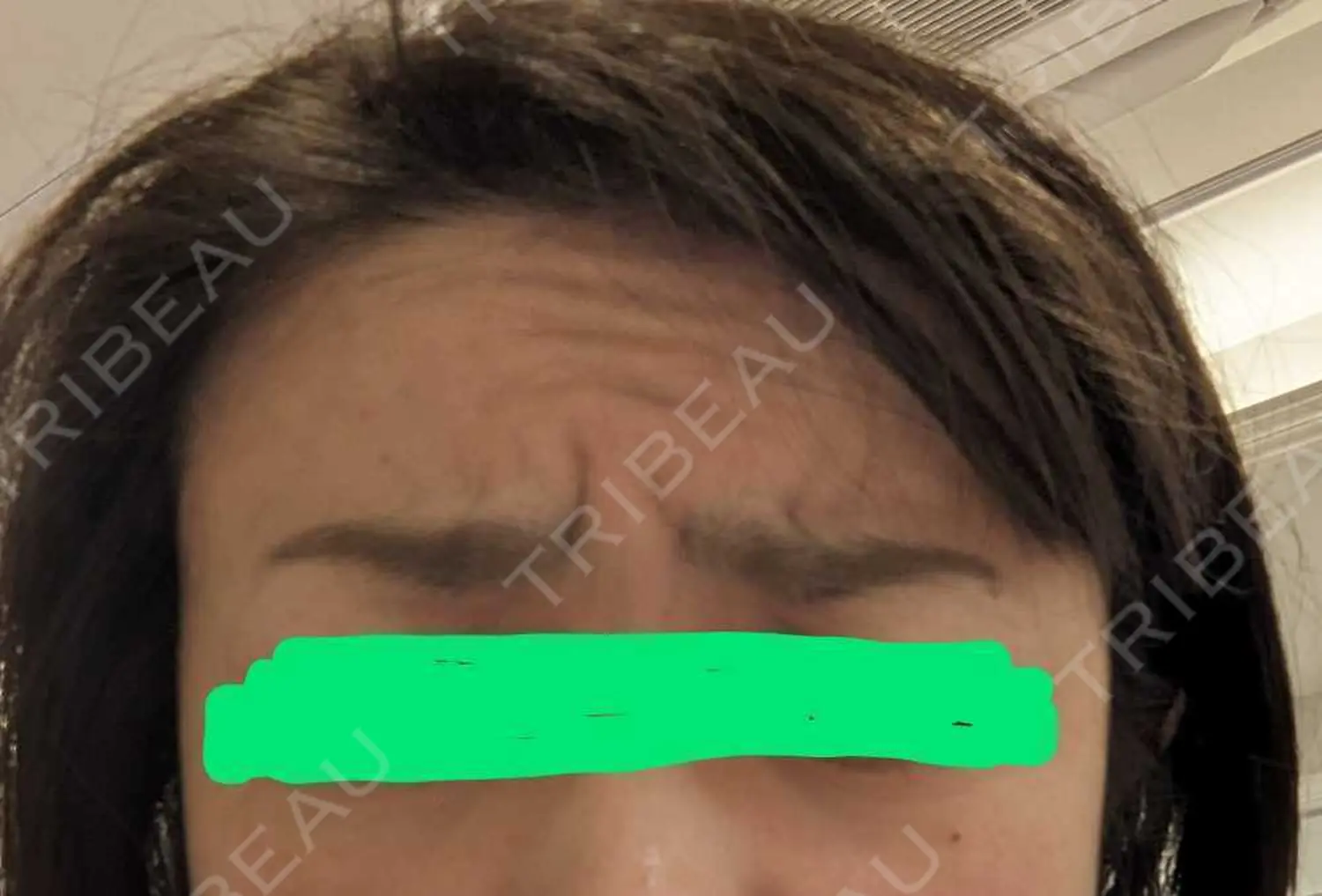 施術後の写真