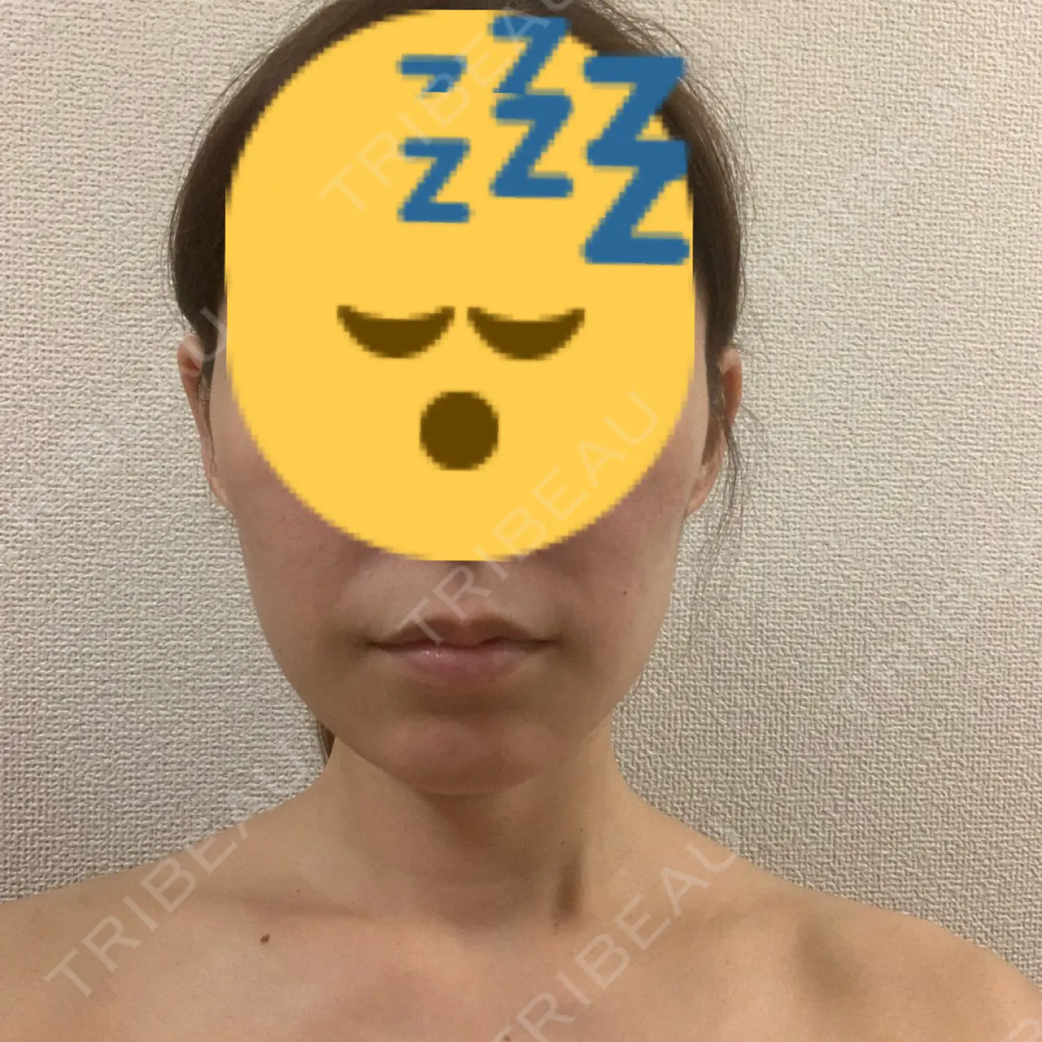 施術後の写真