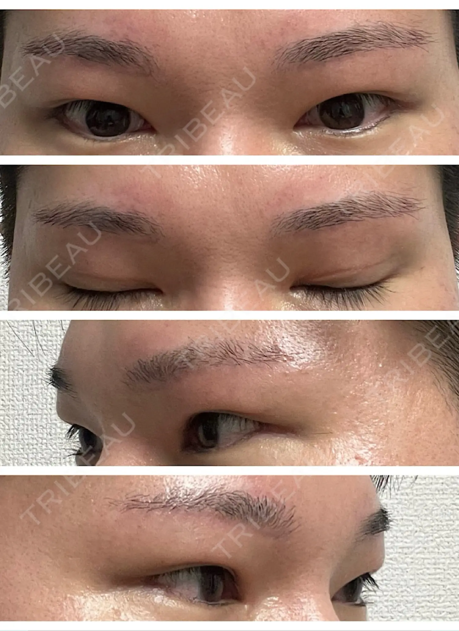 施術後の写真