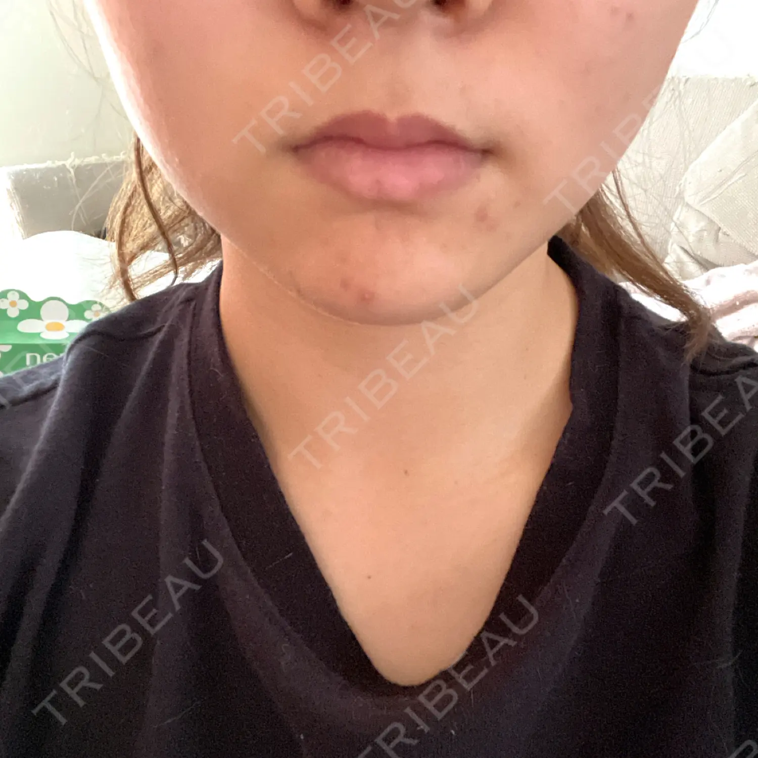 施術後の写真