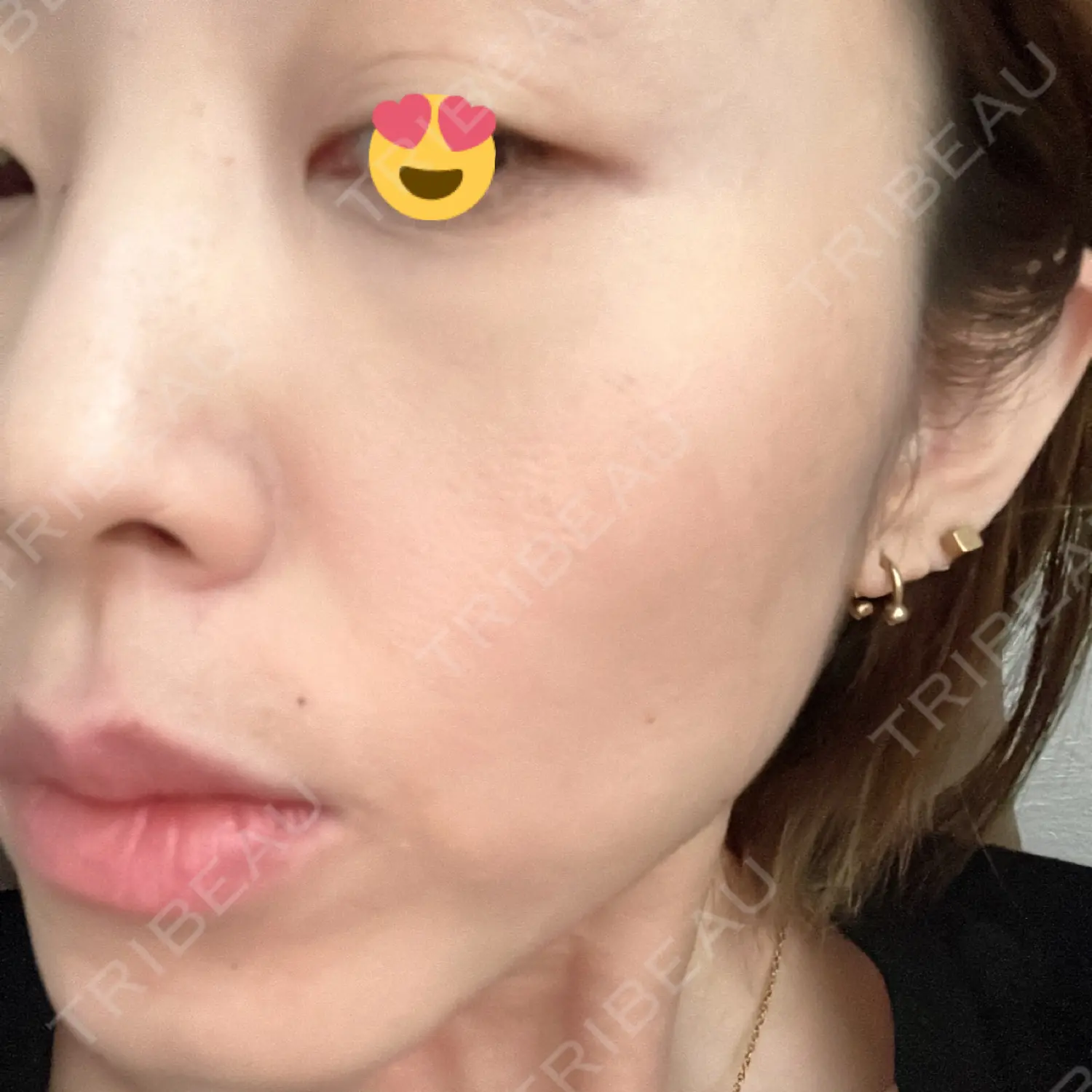 施術後の写真