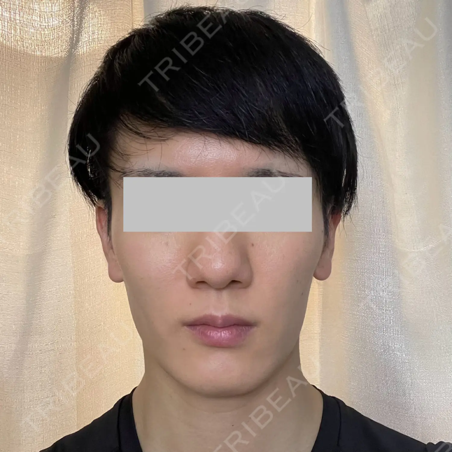施術後の写真