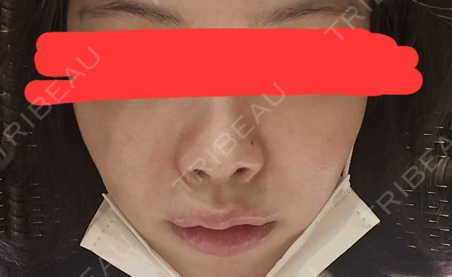 施術後の写真