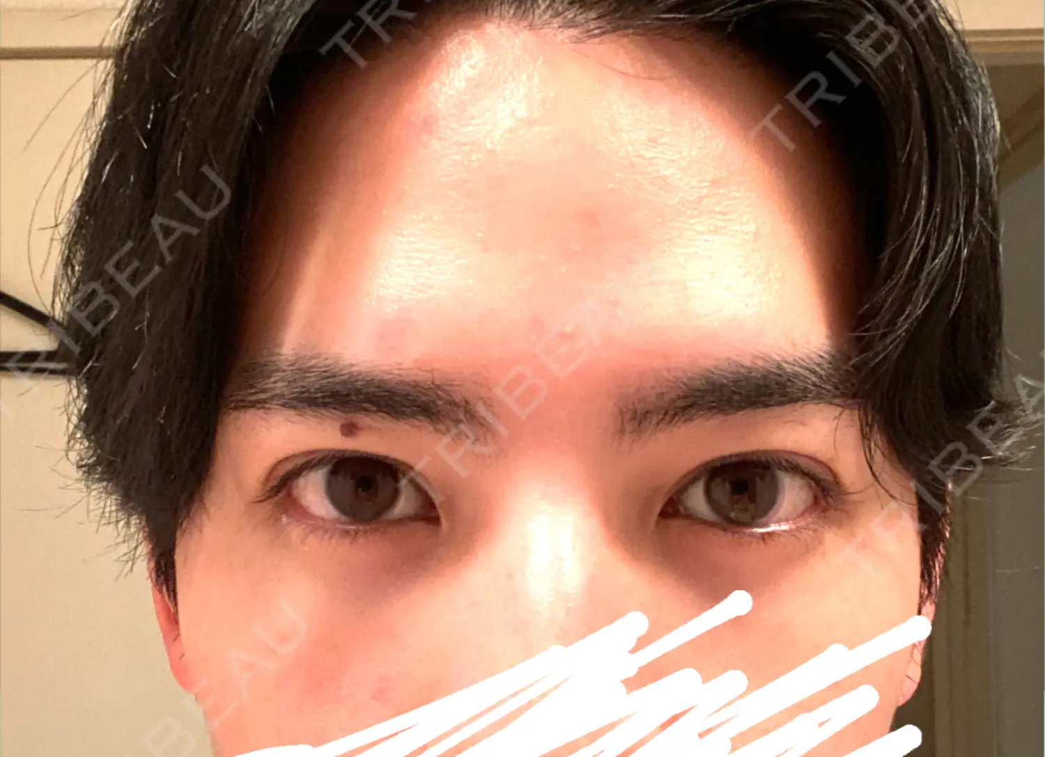 施術後の写真