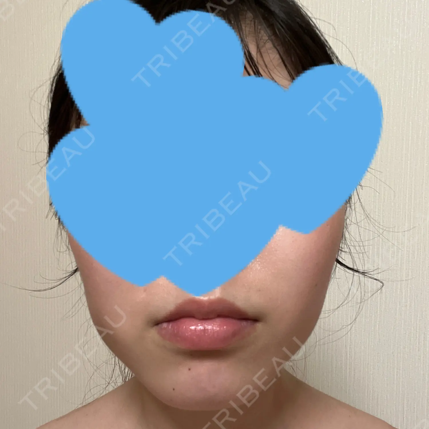 施術後の写真