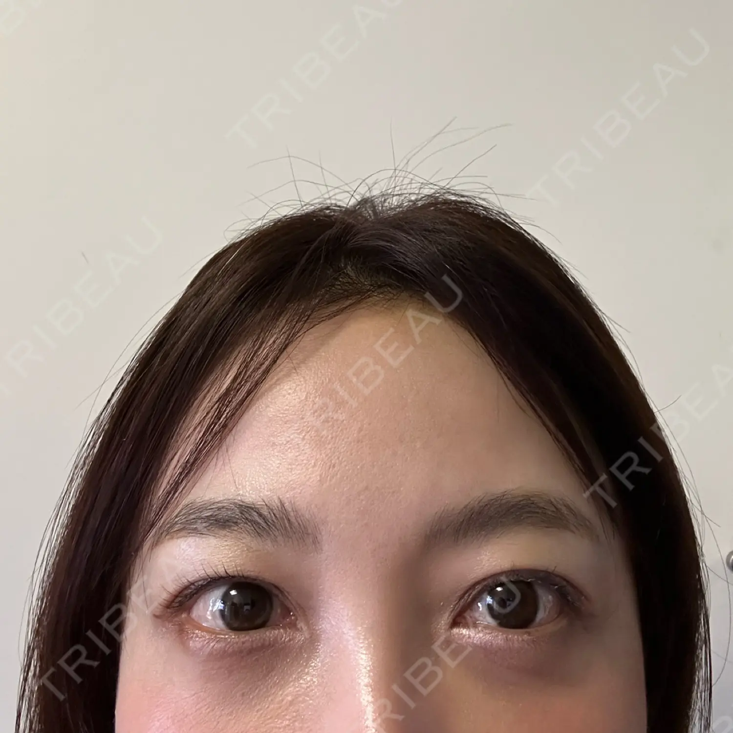 施術後の写真