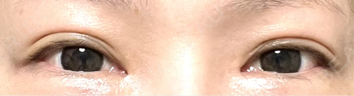 施術後の写真