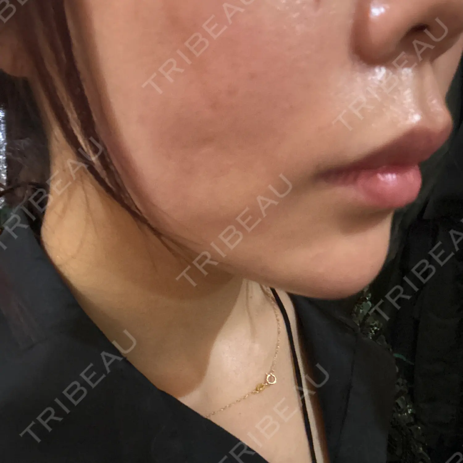 施術後の写真